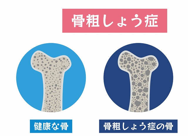 骨粗しょう症