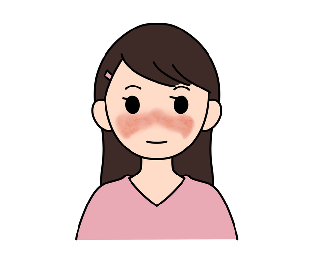 全身性エリテマトーデス（SLE）